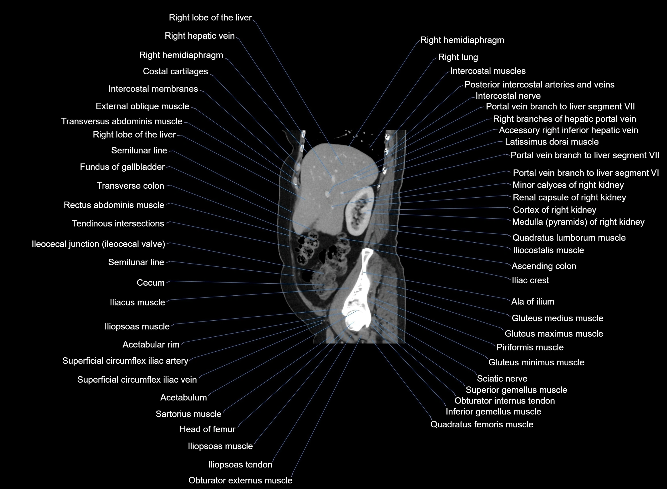 CT Abdomen sagittal cross sectional anatomy labelled radiology image -00084.webp